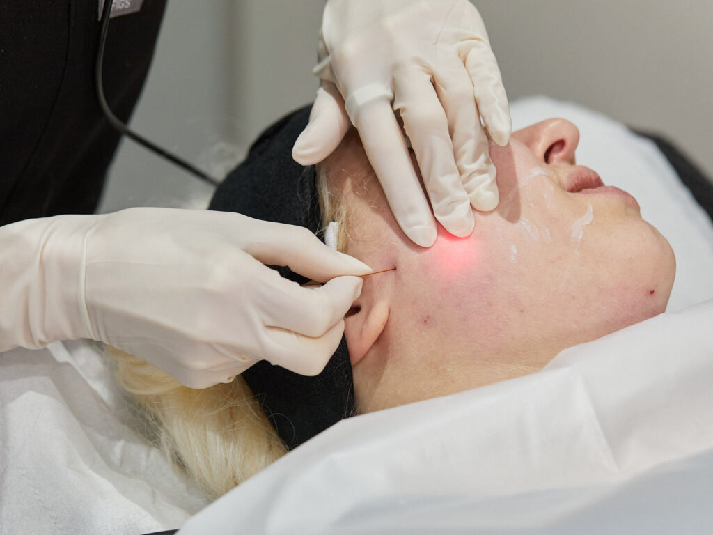 Advanced Laser & Radio Frequency - Facial Sculpting