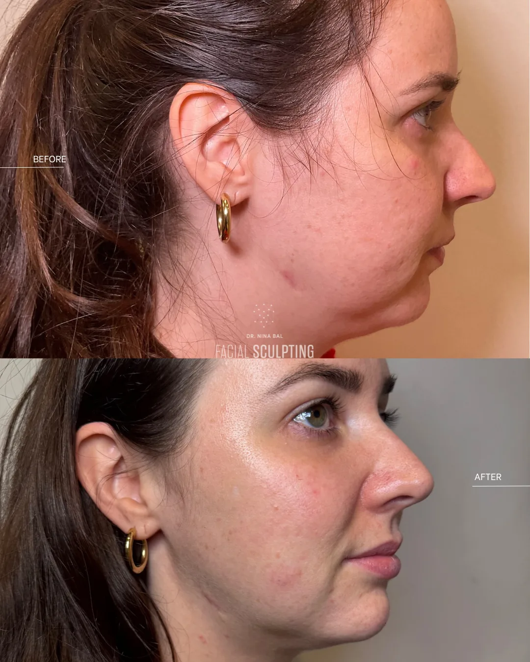 Jalupro Young Eyes patient before and after in profile: revitalised under-eye area, part of a combination treatment plan