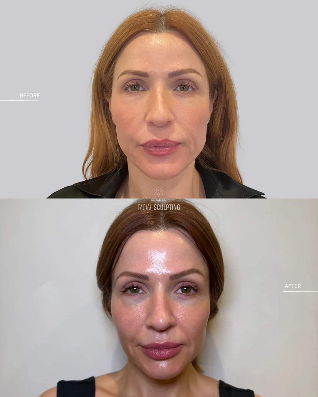 Jalupro Young Eyes patient before and after: a fresher, more rested eye area and improved skin quality, combination plan