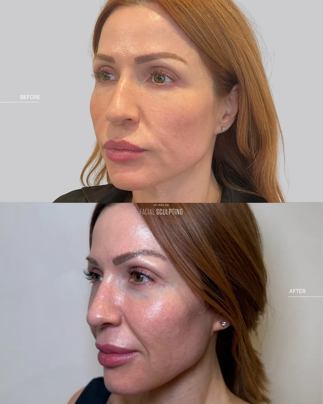 Julaine patient before and after, three-quarter view: improved skin quality and gentle firmness, combination plan