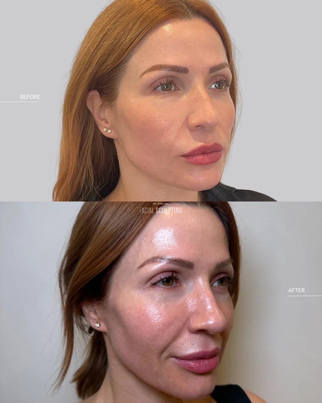 Jalupro Super Hydro patient before and after, three-quarter view: smoother, more luminous skin, combination plan