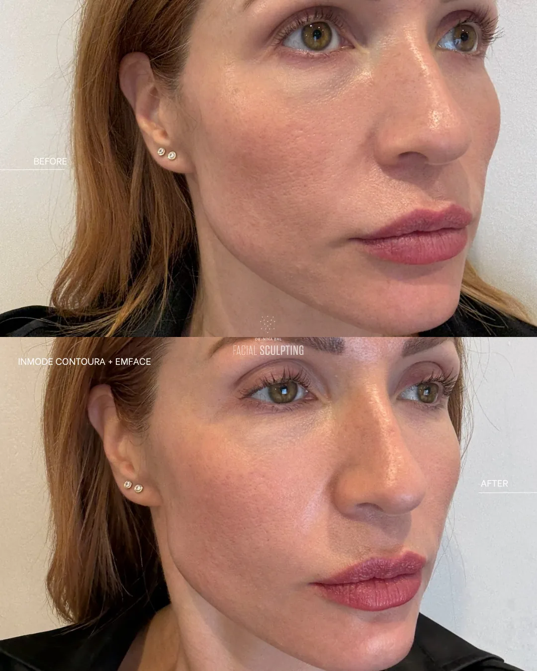InMode Contoura patient before and after: lifted mid-face and refined jawline, shown with EMFACE