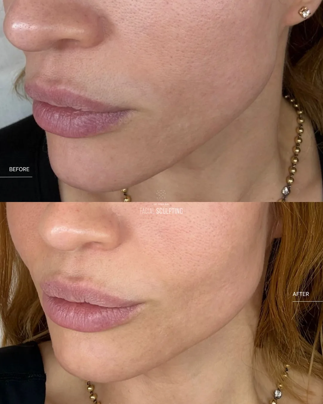 InMode Contoura patient before and after: firmer jawline and smoother lower-face contour, combination plan