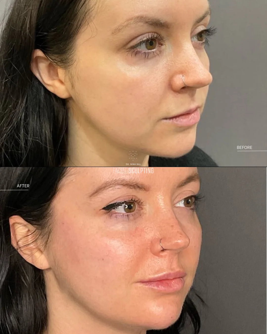 Endolift before and after at Facial Sculpting London: firmer jawline, brighter under-eyes and a refreshed lower face as part of a combination plan