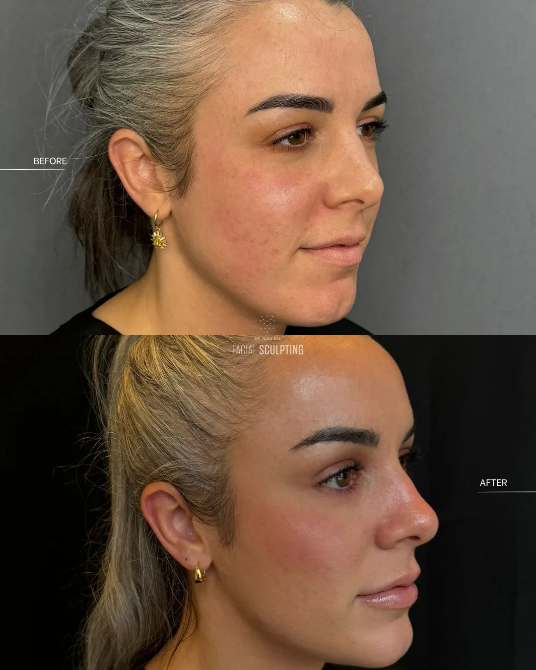 Endolift patient before and after, three-quarter view: tighter lower face and improved skin quality, combination treatment plan