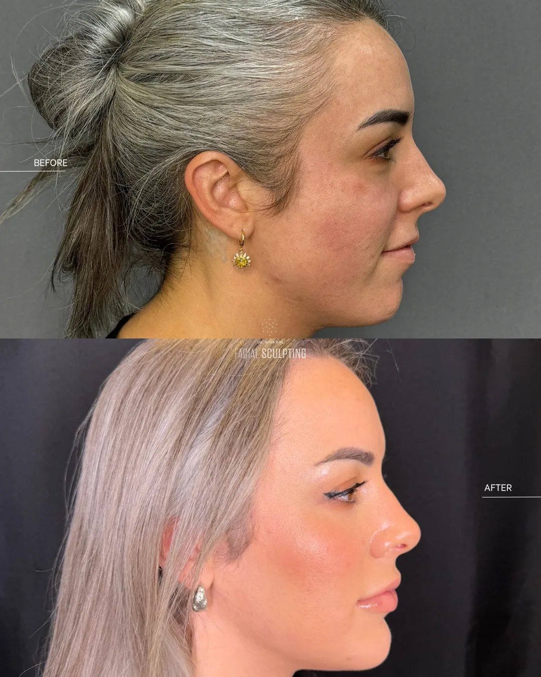 Endolift patient before and after, side profile: sharper jawline definition and lifted lower face, combination treatment plan