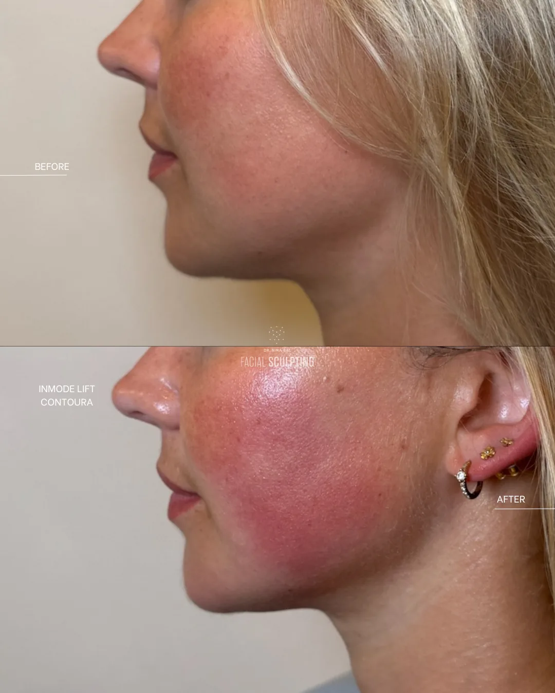 InMode Contoura patient before and after, side profile: sharper jawline definition, combination plan