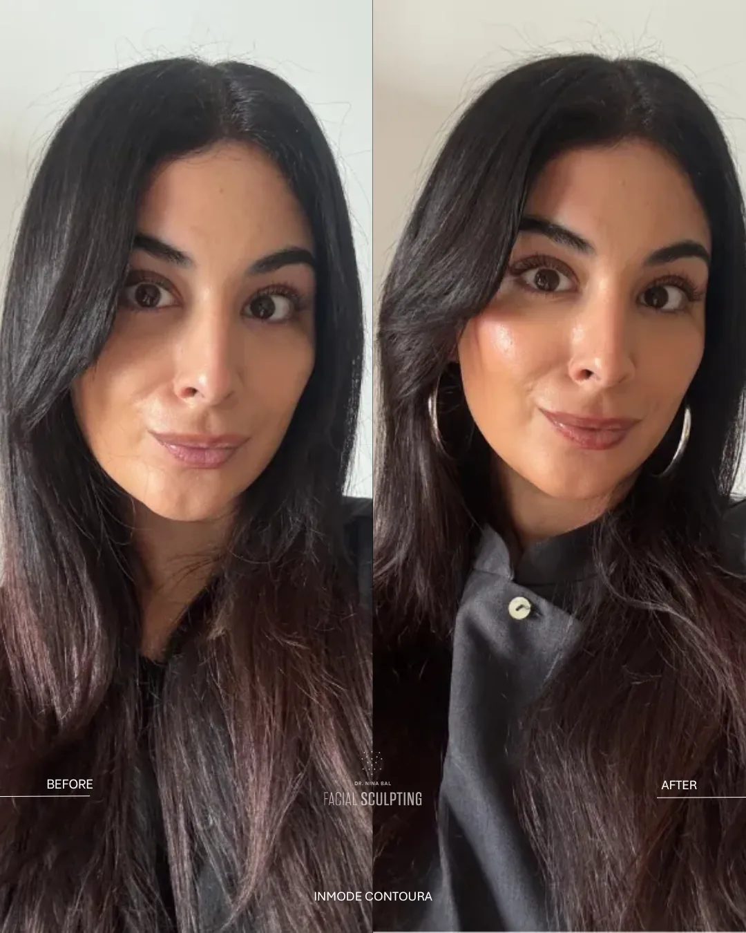 InMode Contoura before and after at Facial Sculpting London: contoured cheeks and jawline with tighter-looking skin