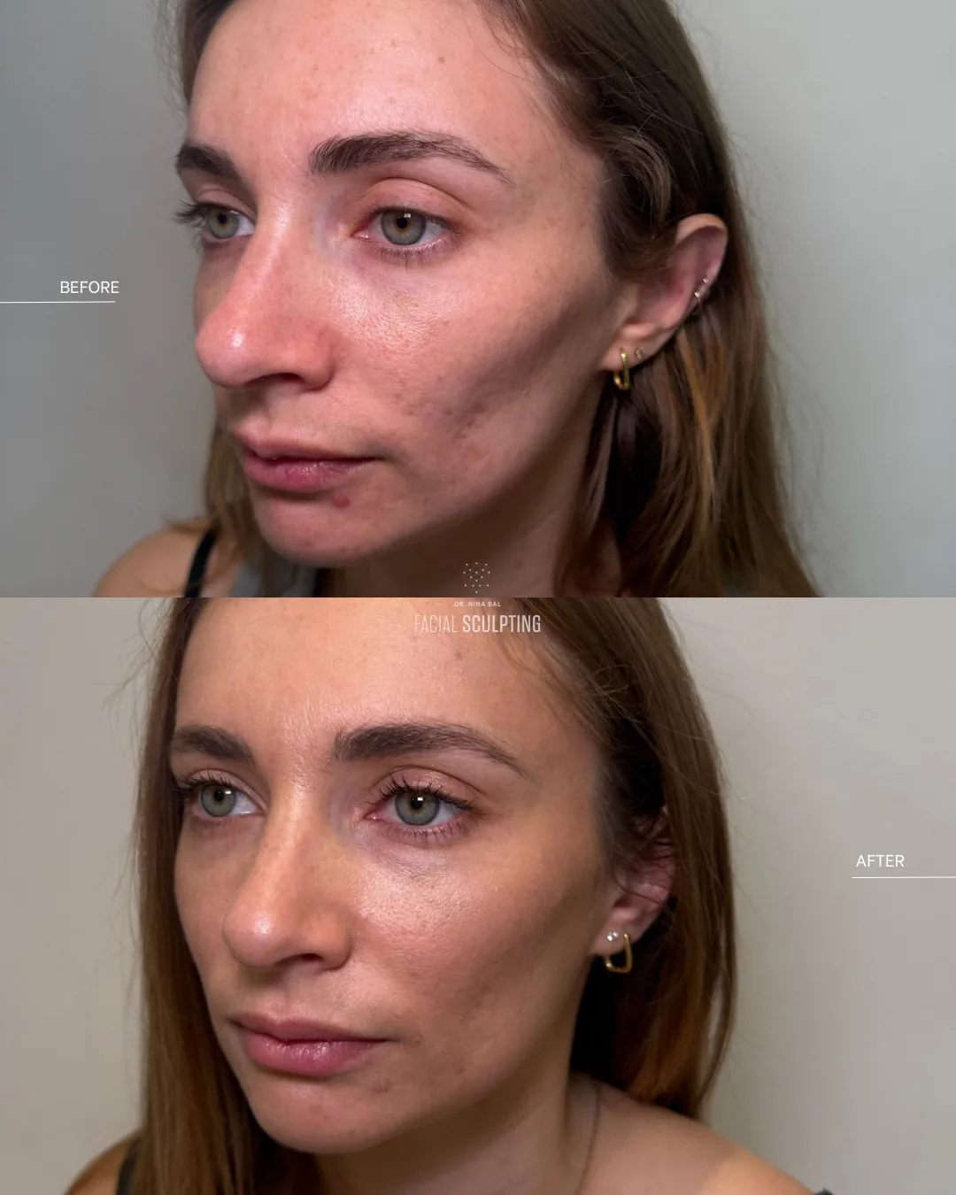 Lip enhancement patient before and after: subtly enhanced lip shape and hydration, combination treatment plan