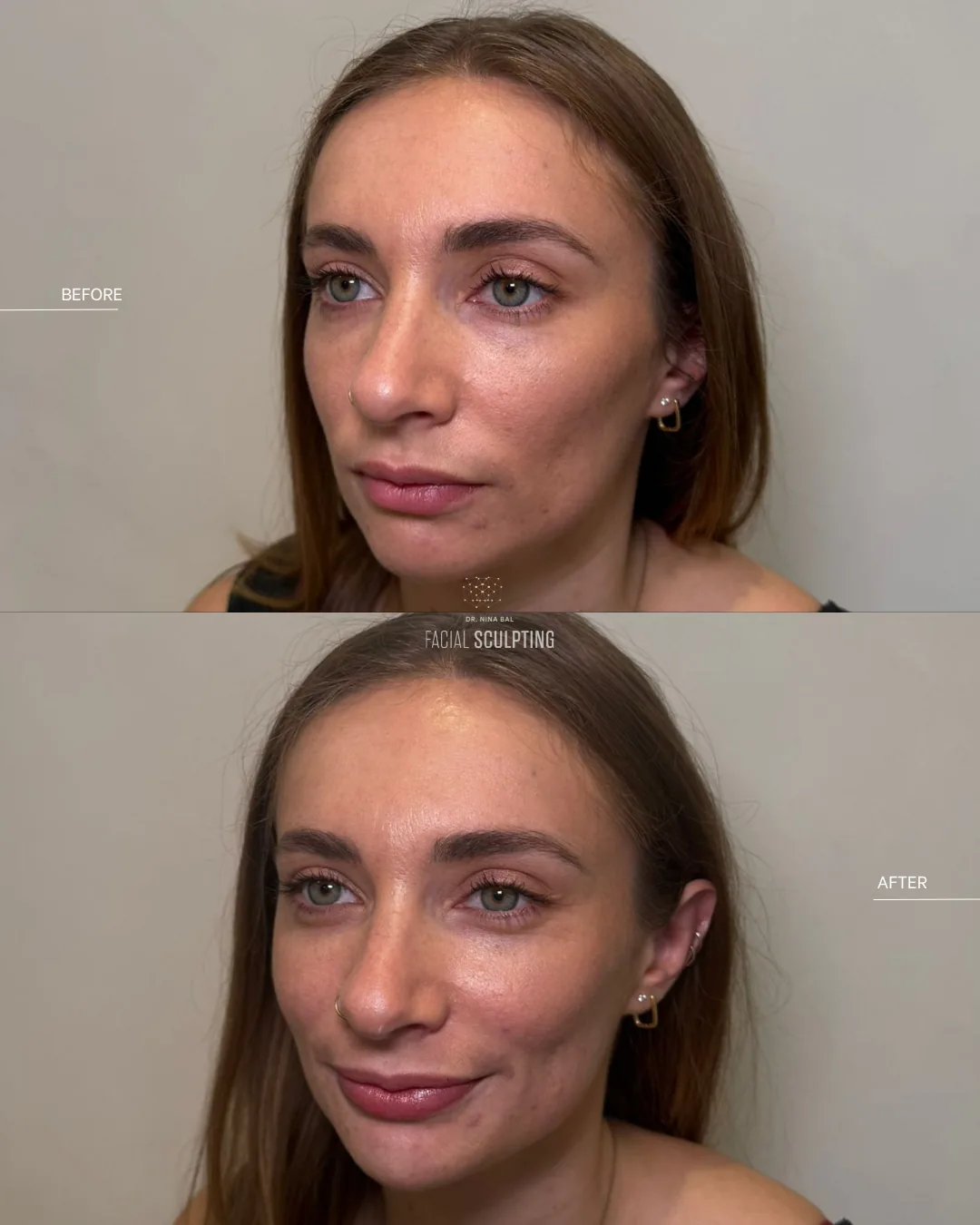 Lip enhancement patient before and after, three-quarter view: balanced, natural-looking lip volume, combination plan