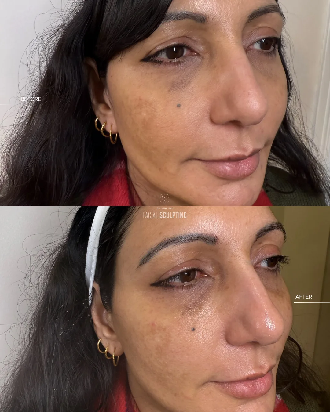 Before and after Lutronic LaseMD: visibly reduced pigmentation and more even skin tone