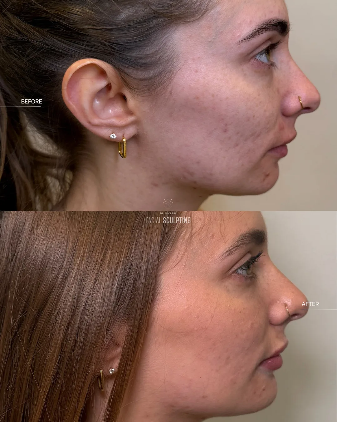Before and after Lutronic LaseMD, side profile: visibly clearer, calmer skin with refined texture
