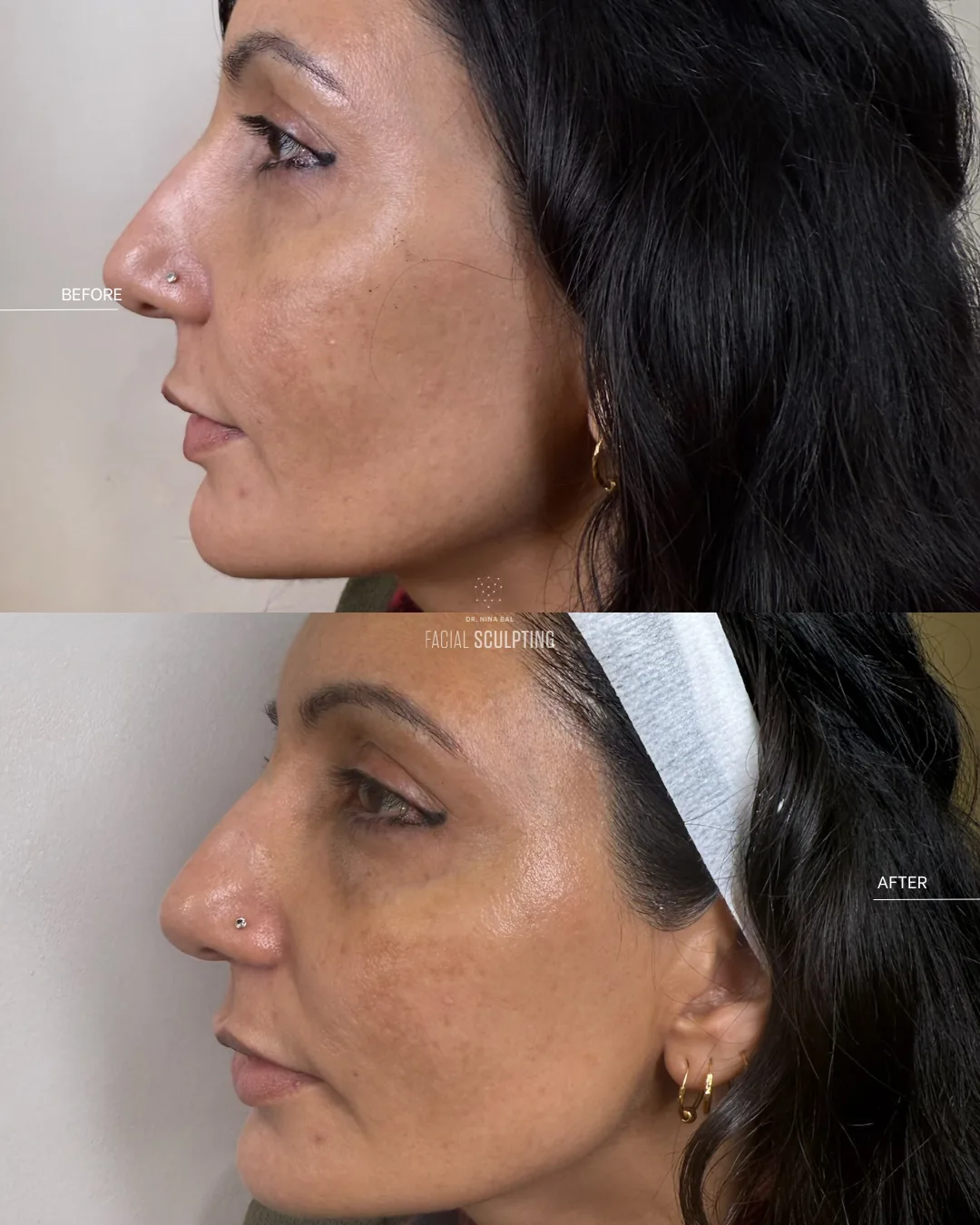 Before and after Lutronic LaseMD, side profile: brighter, smoother skin with improved tone