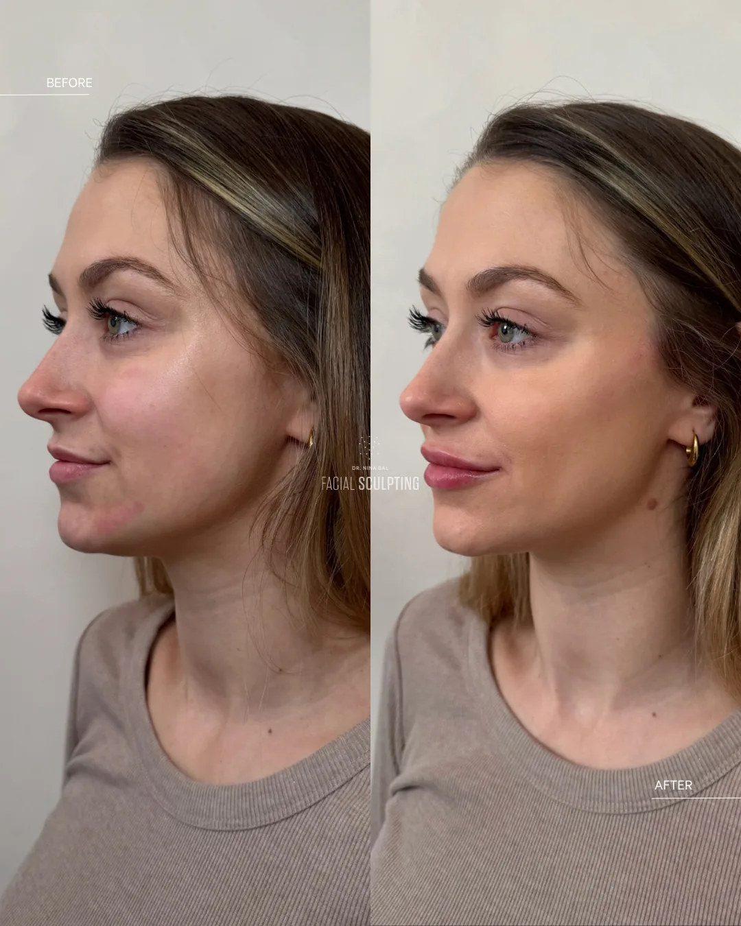 Lower-face before and after in profile: chin and jawline balance refined within a combination plan