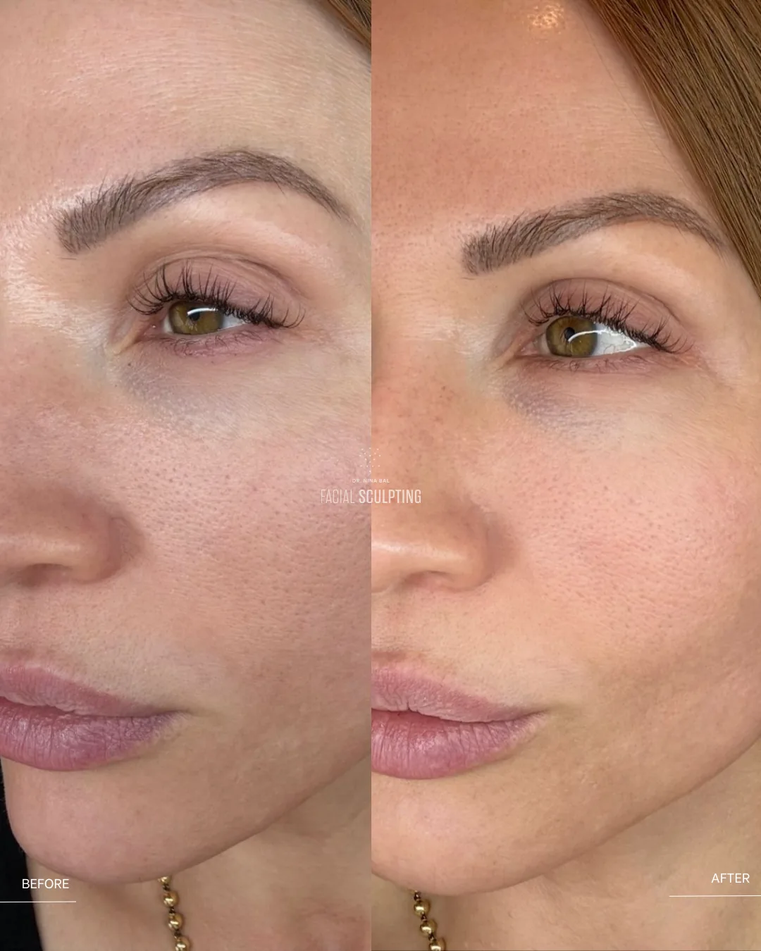Jalupro Super Hydro before and after at Facial Sculpting London: deeply hydrated, firmer-looking skin around the eyes and mid-face