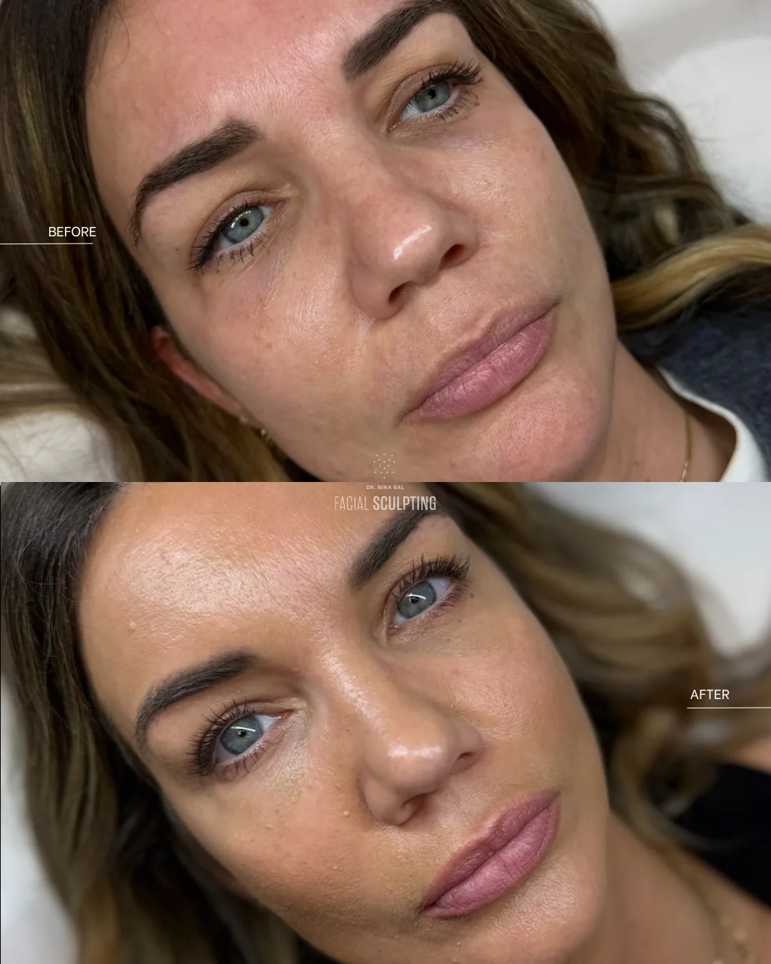 Polynucleotides under-eye before and after at Facial Sculpting London: brighter, smoother under-eyes and fresher skin
