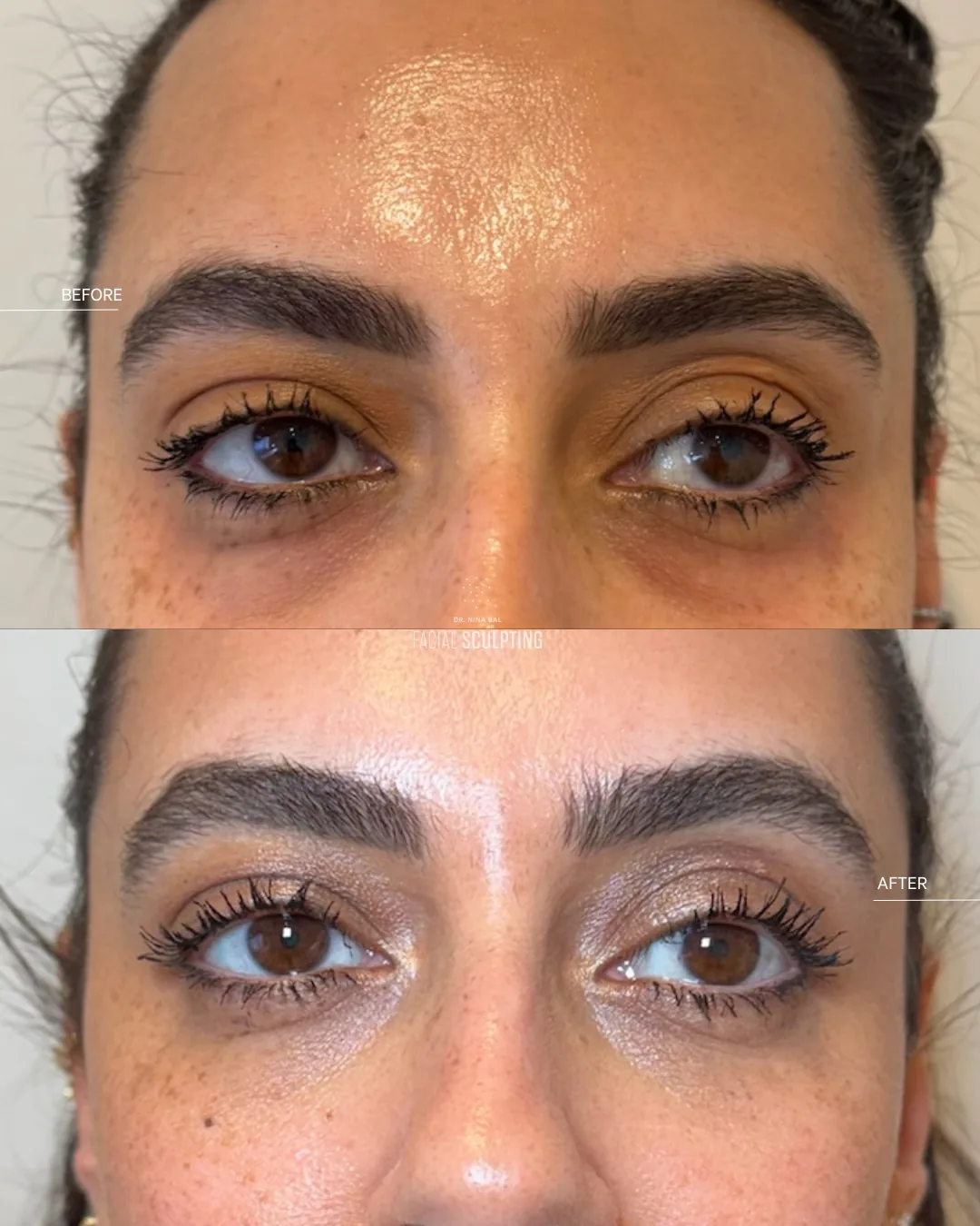Jalupro Young Eyes before and after at Facial Sculpting London: brighter under-eyes with softened hollows, combination plan