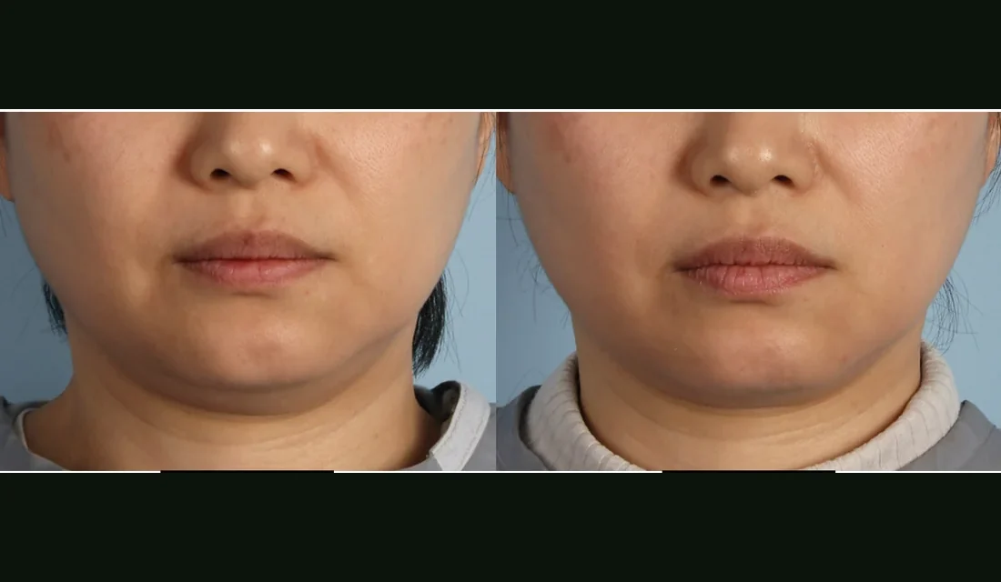 XERF before and after, jawline and lower face contour one month after one treatment