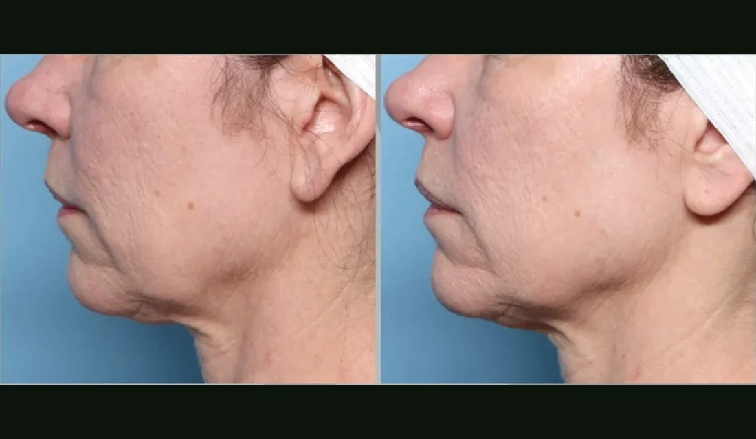 XERF before and after, jawline and neck tightening after two treatments