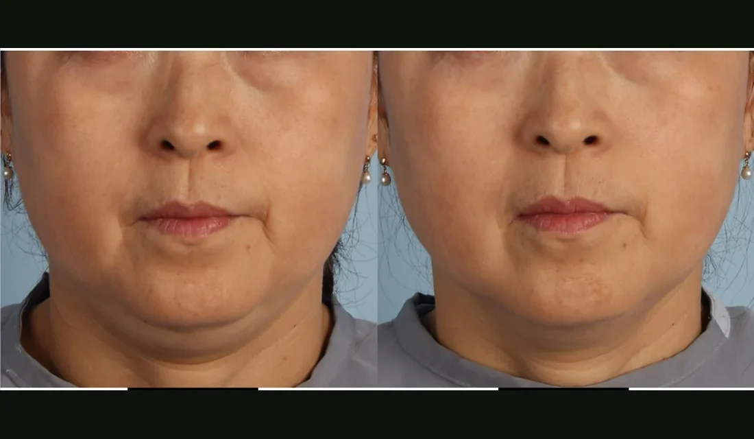 XERF before and after, lower face firmness one month after one treatment