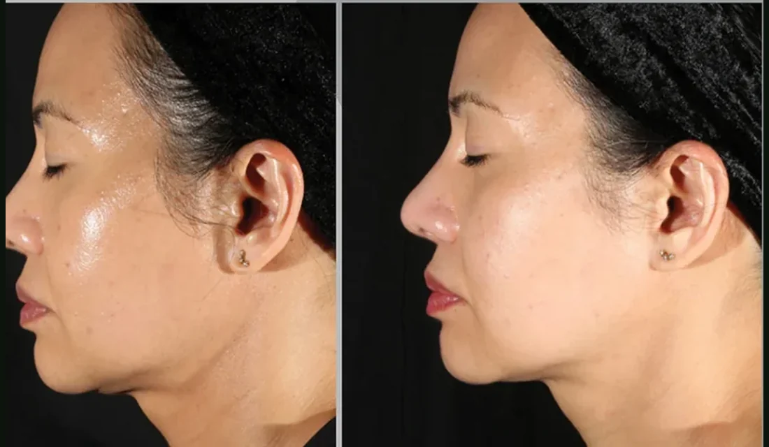 XERF before and after, side profile skin tightening after one treatment