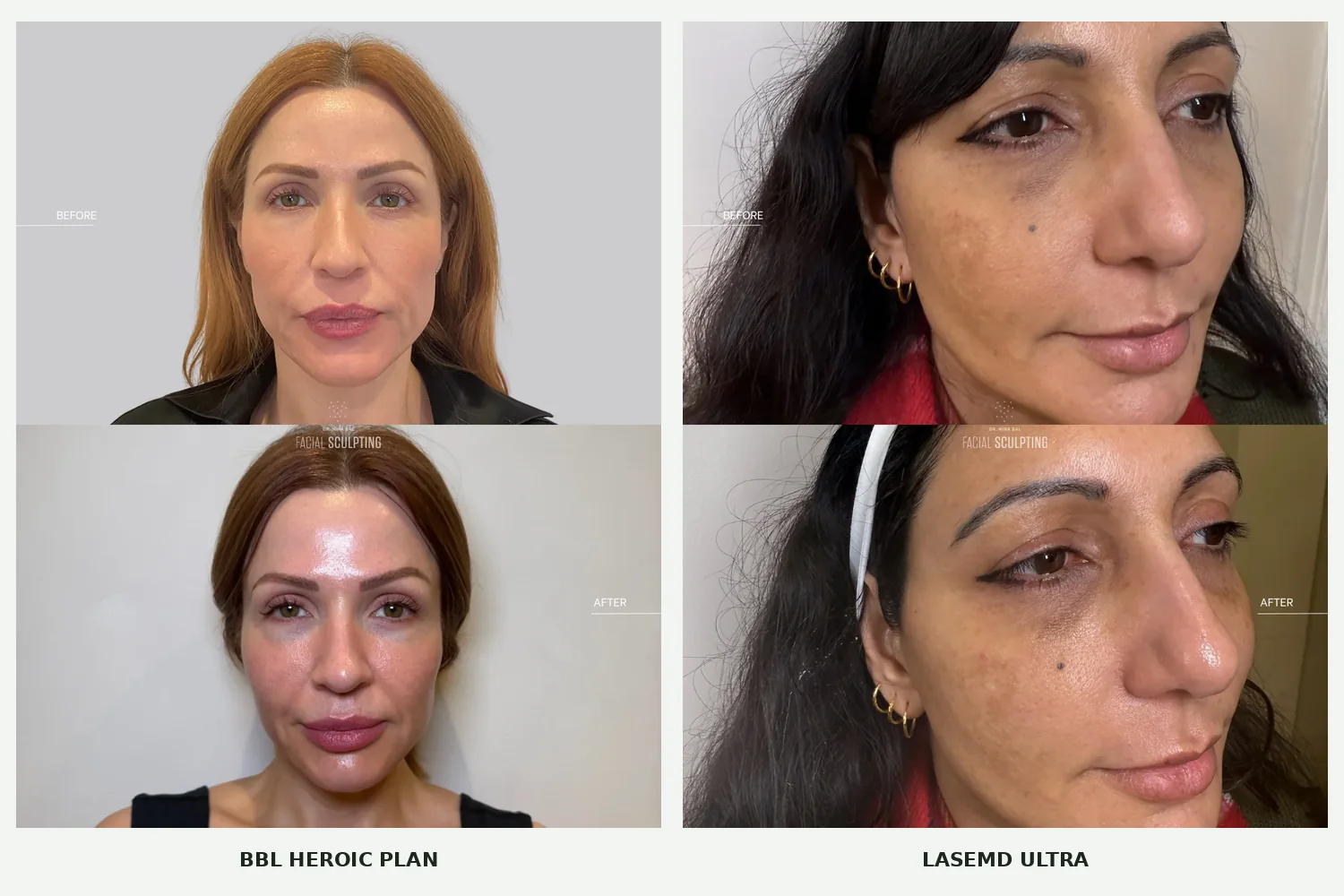 Real Facial Sculpting patients before and after: a BBL HEROic combination plan on the left and Lutronic LaseMD Ultra for pigmentation on the right; individual results vary